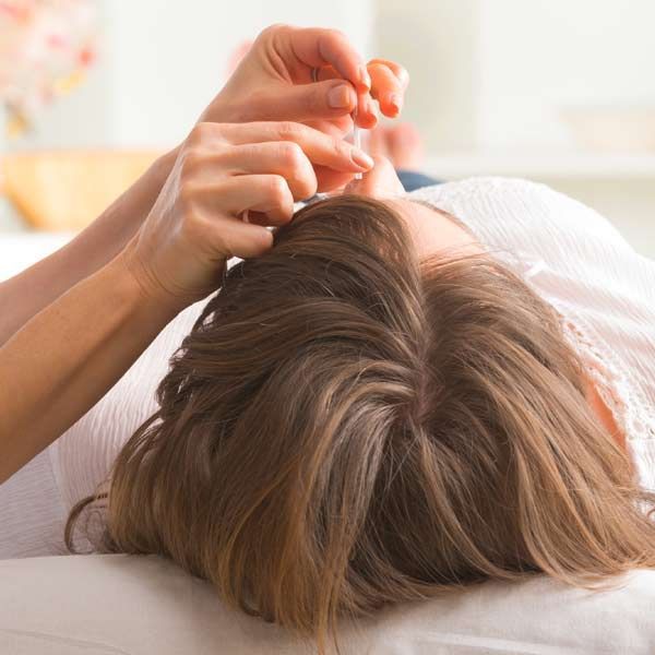 A woman receiving acupuncture on her head, lying on a white surface; an acupuncturist's hands holding needles.