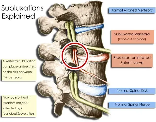 Illustration of a spinal vertebra subluxation with labeled normal and misaligned vertebrae, discs, and nerve irritation