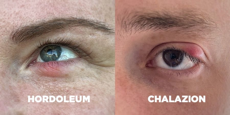 Patients with different types of eyelid bumps