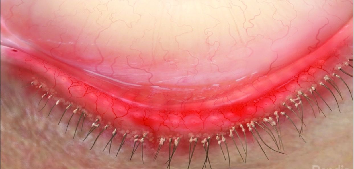 A close up of a person 's eye with blepharitis from Demodex mites