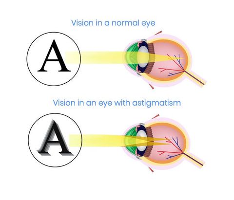 Astigmatism | Focal Pointe Eye Care