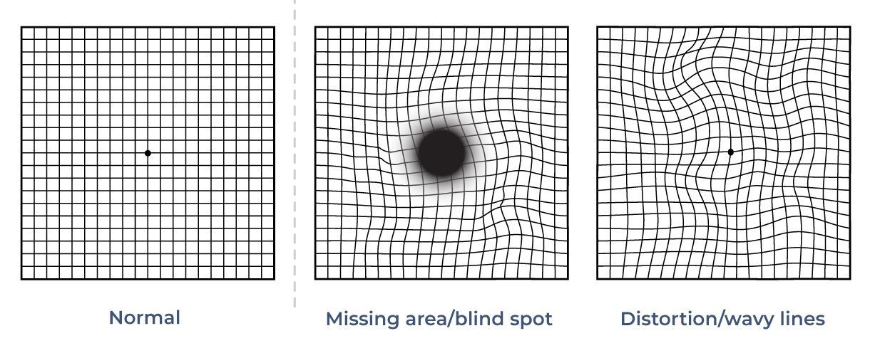 A drawing of a normal eye , a missing eye , and a distorted eye.