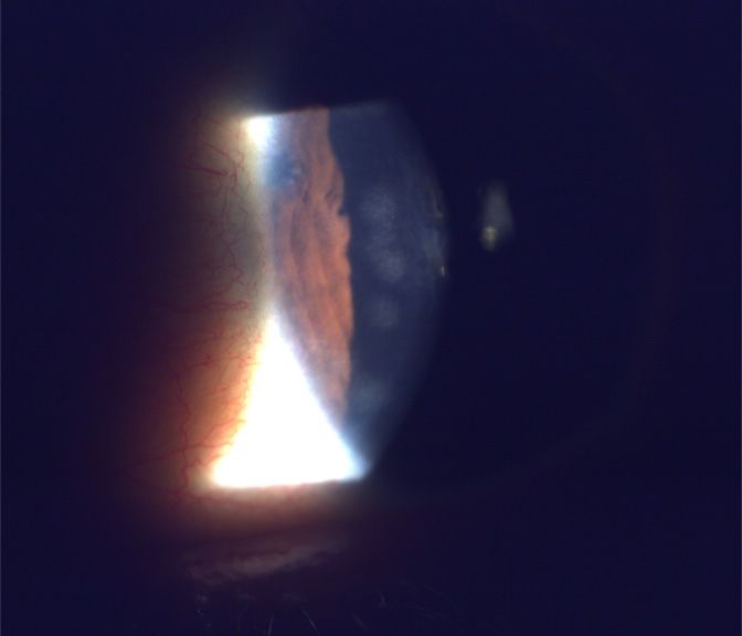 Eye examination view showing brown iris, clear cornea, and bright light.
