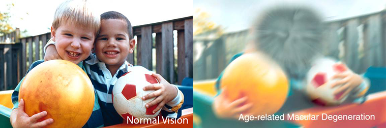 boys seen with normal vision on left and AMD on left