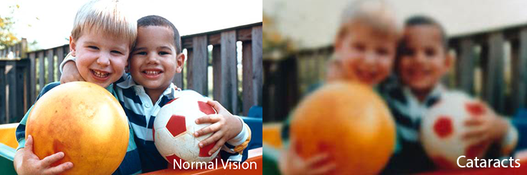 boys as seen with normal vision on one side and cataracts on the other