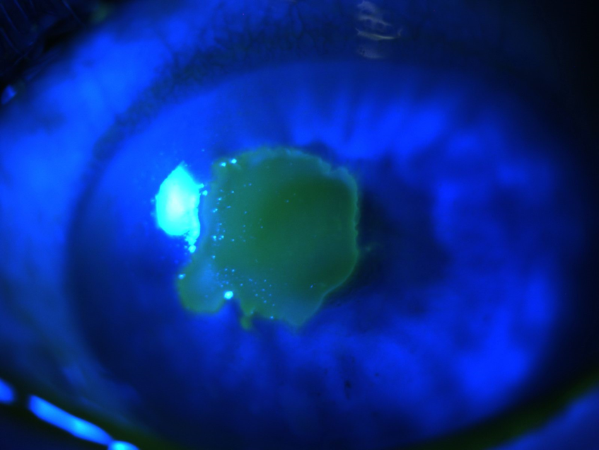 A close up of a person 's eye with a corneal ulcer