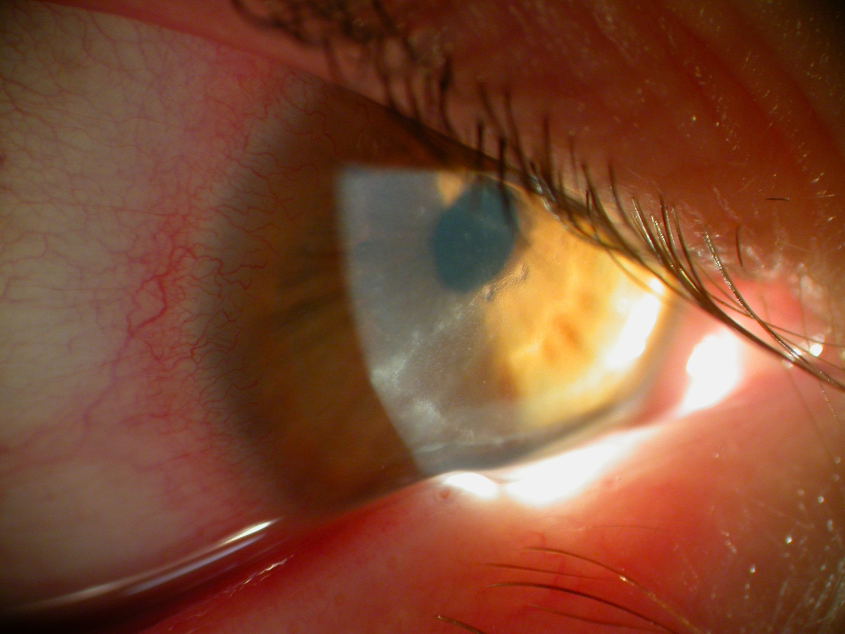 A close up of a person 's eye with a corneal ulcer caused by Acanthomeba