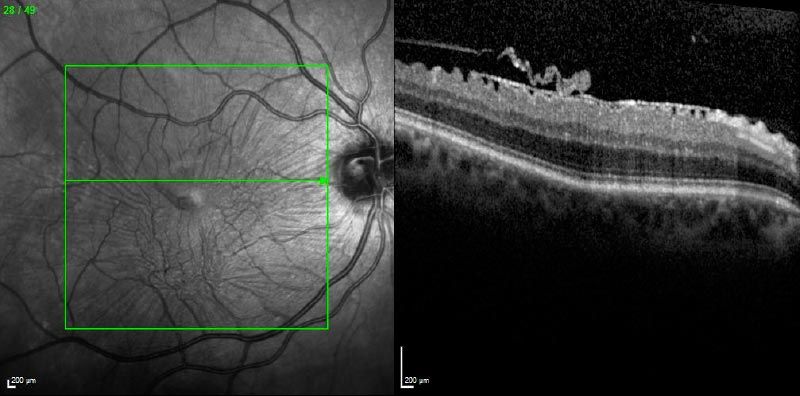 macular pucker