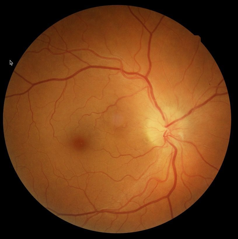 A close up of a person 's eye with optic neuropathy
