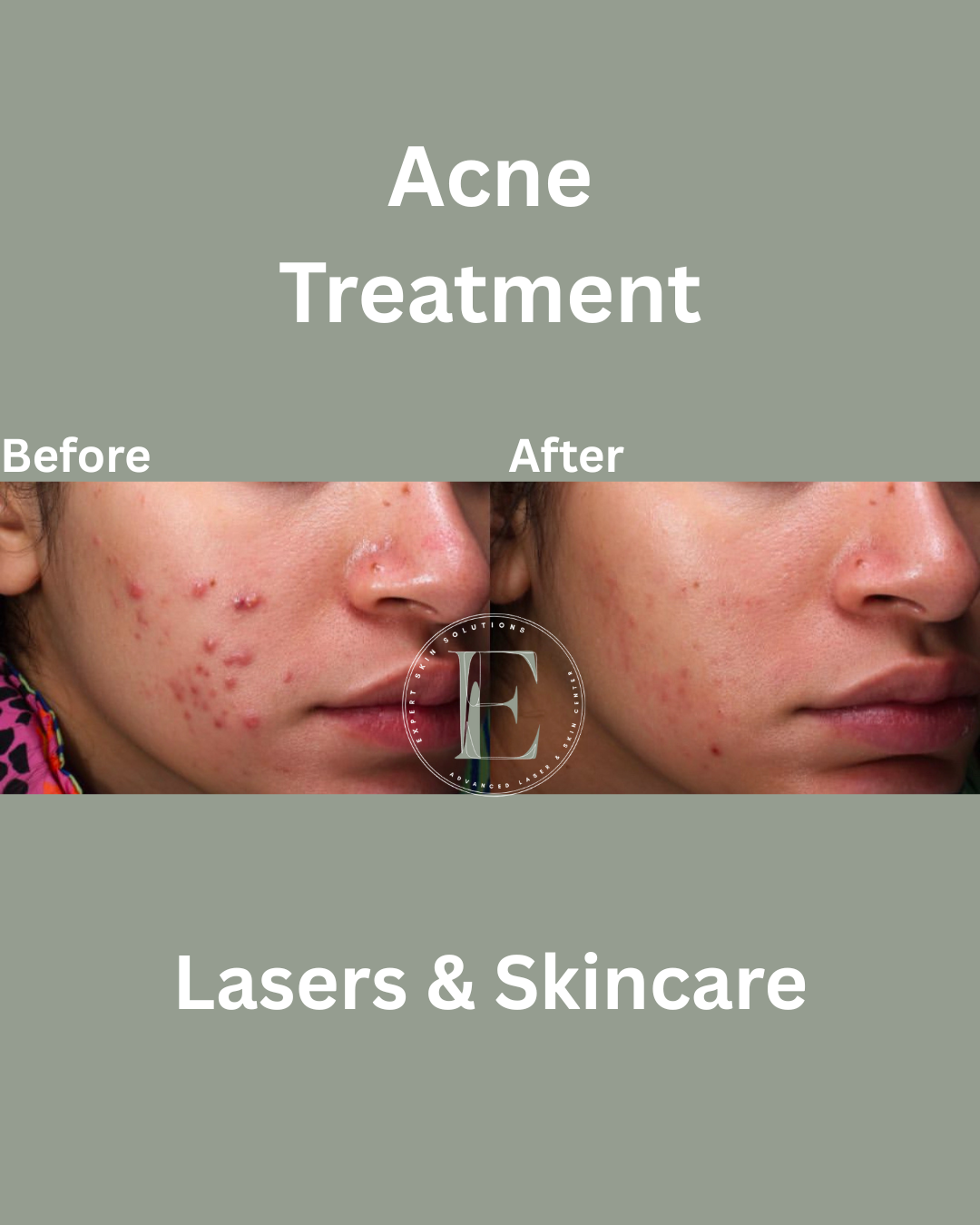 acne treatment