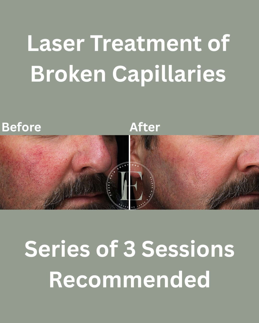 laser treatment for broken capillaries results by ava Najafabadi