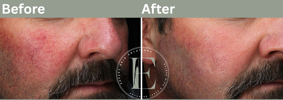 laser treatment for broken capillaries results by ava Najafabadi