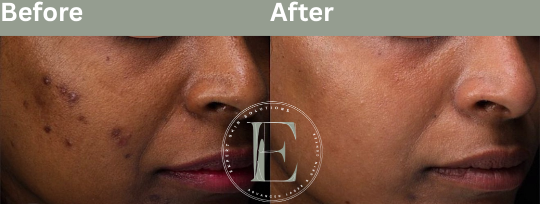 Results from using hydroquinone and tretinoin based skincare regimen by Ava Najafabadi Master Aeshtetician