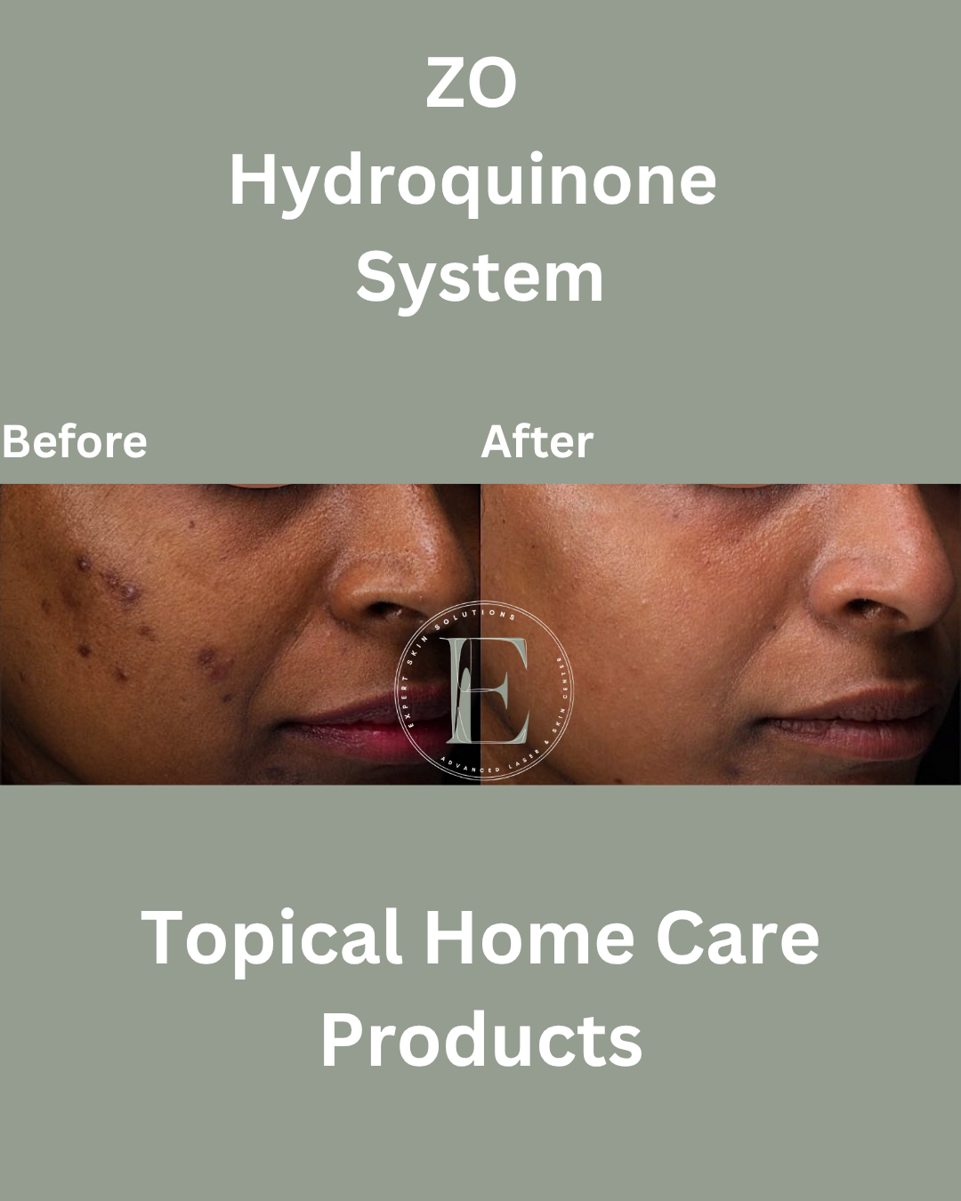 Results from using hydroquinone and tretinoin based skincare regimen by Ava Najafabadi Master Aeshtetician