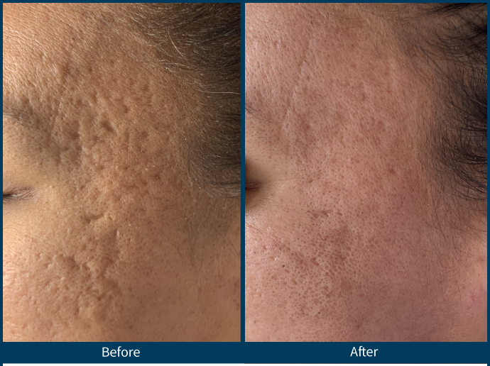 A before and after photo of a woman 's face treated for acne scarring using SkinPen Microneedling