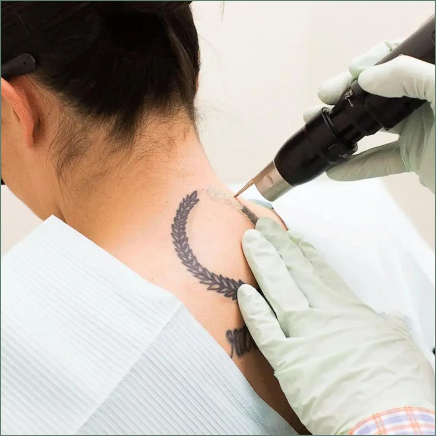 A woman is getting a tattoo removed from her neck