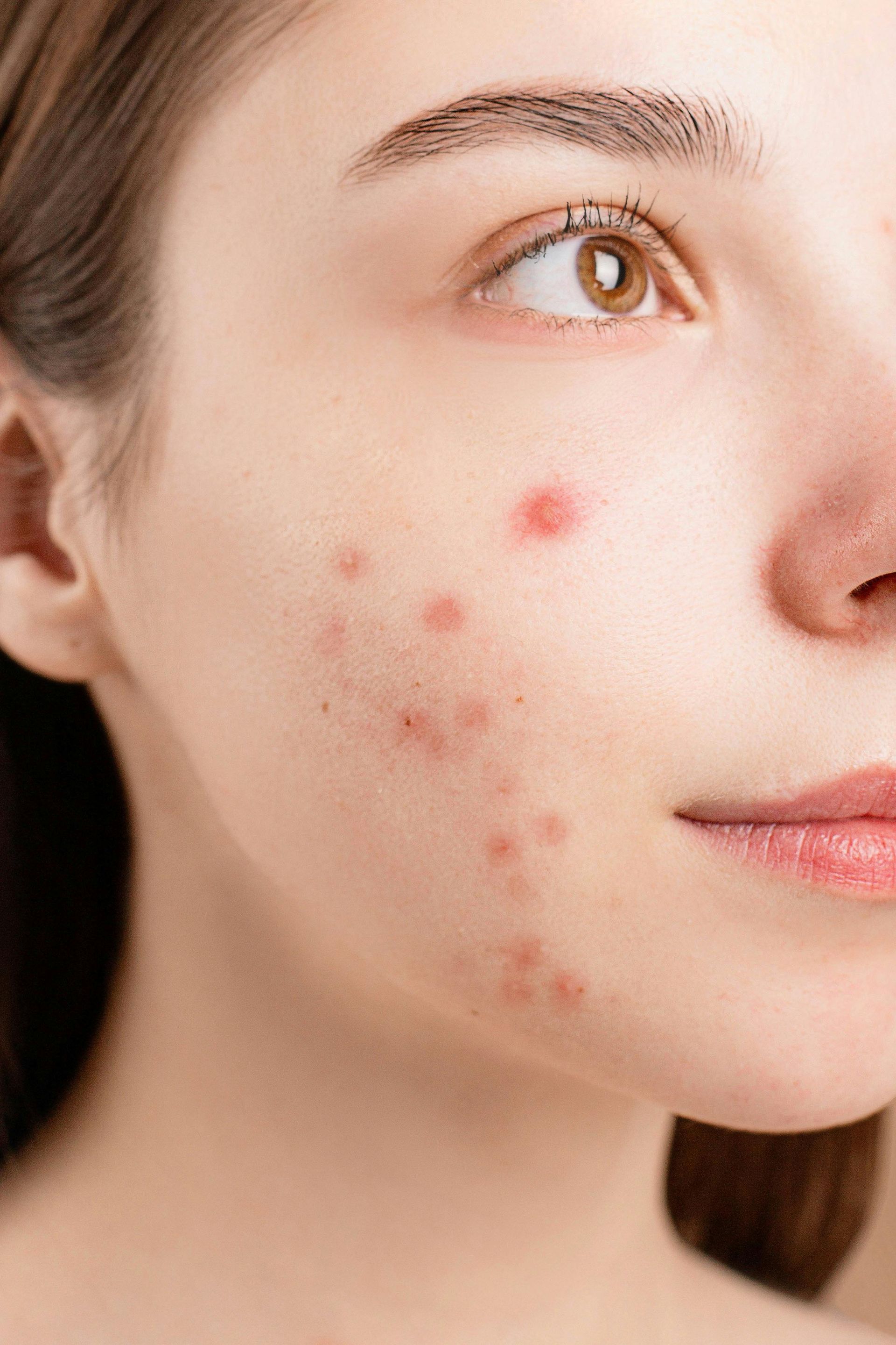 A close up of a woman 's face with acne on it.