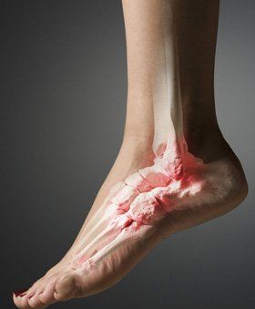 Foot problems - Huddersfield, West Yorkshire - Jayne Oldmeadow - Ankle