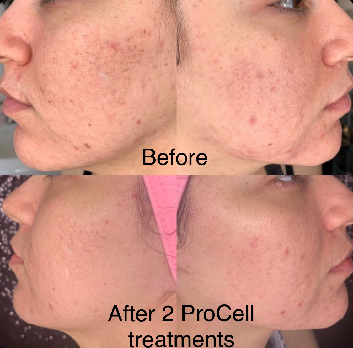 A woman's face is shown before and after 2 procell treatments