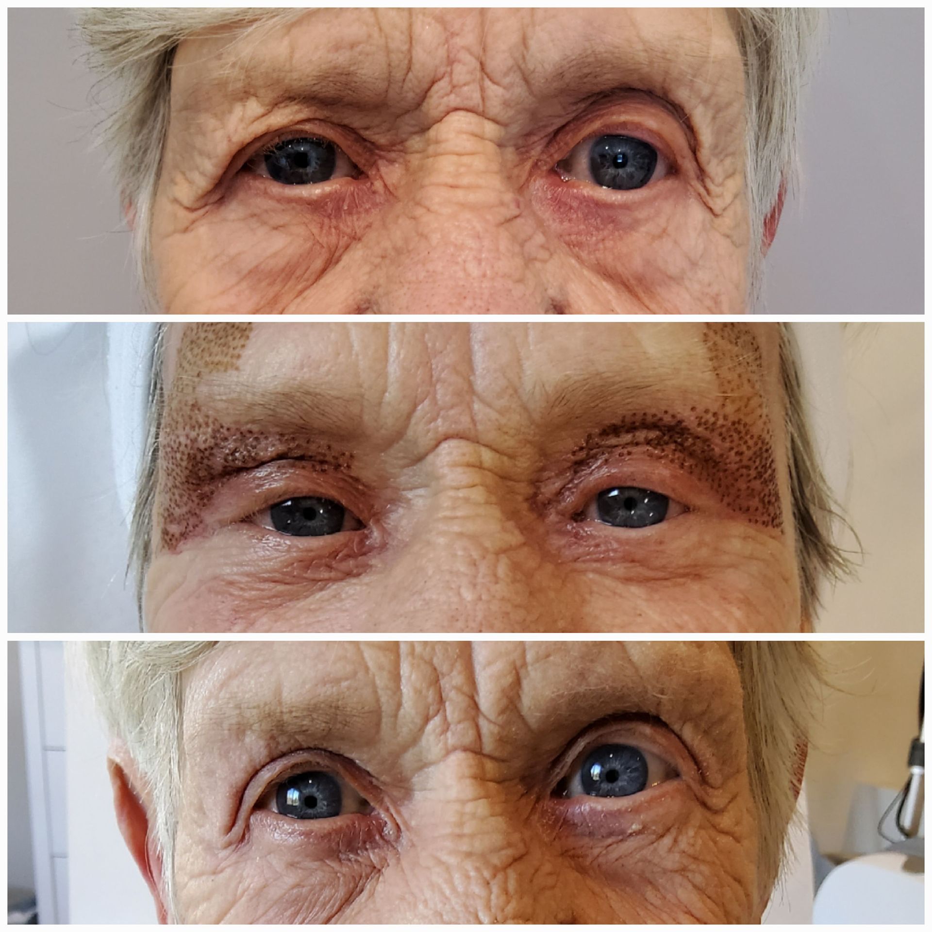 Three pictures of an elderly woman 's eyes before and after surgery