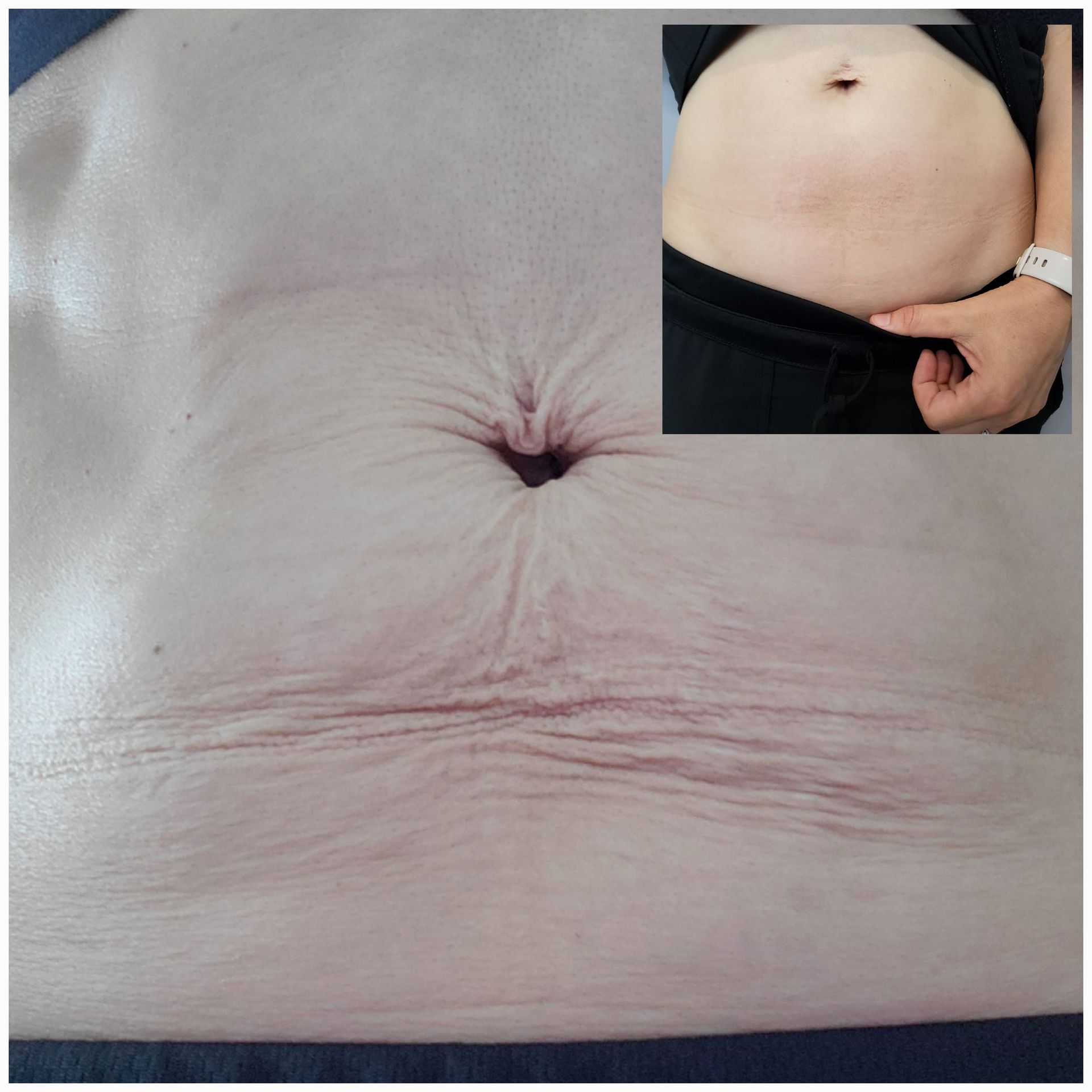 A close up of a woman 's stomach and a picture of a woman 's belly