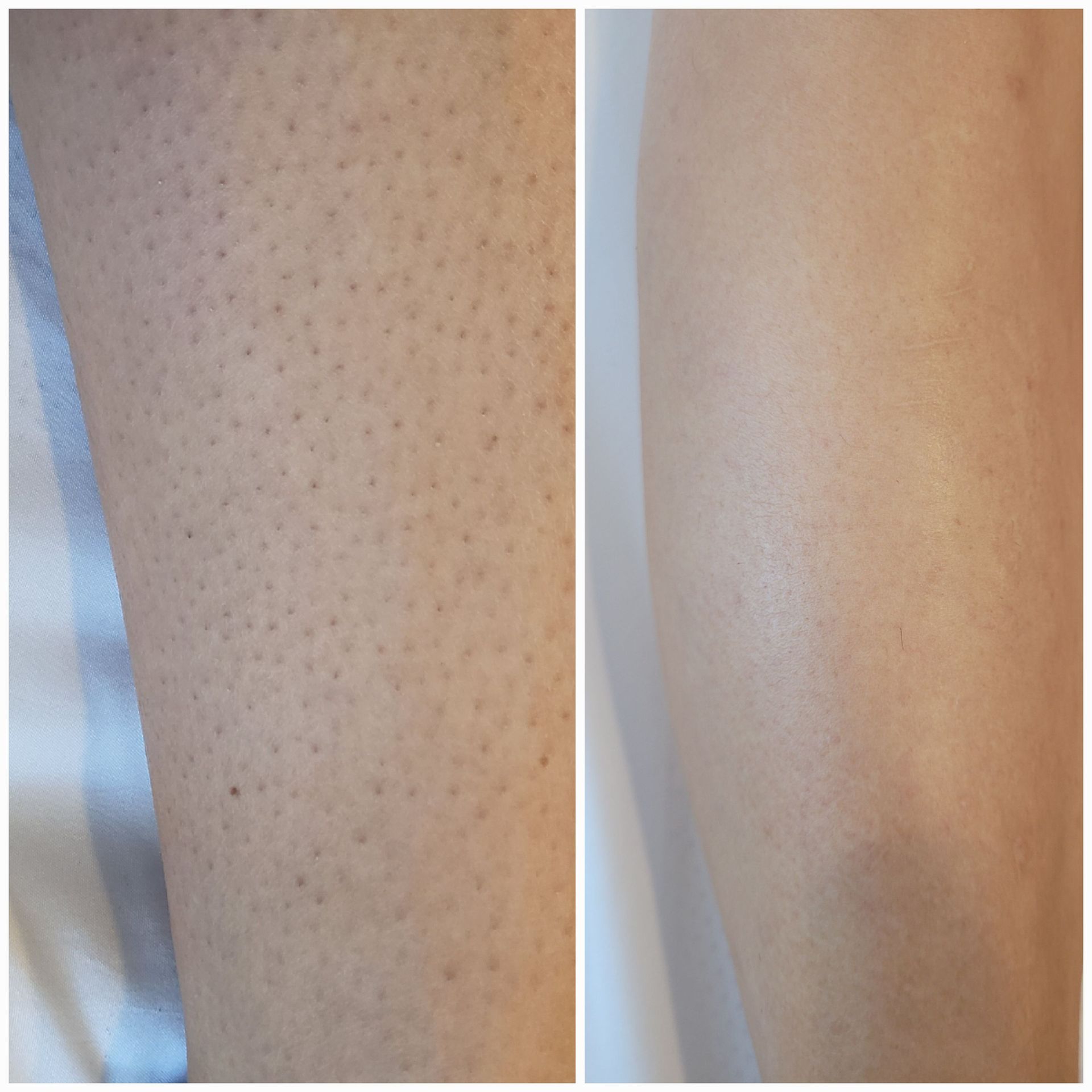 A before and after picture of a person 's leg