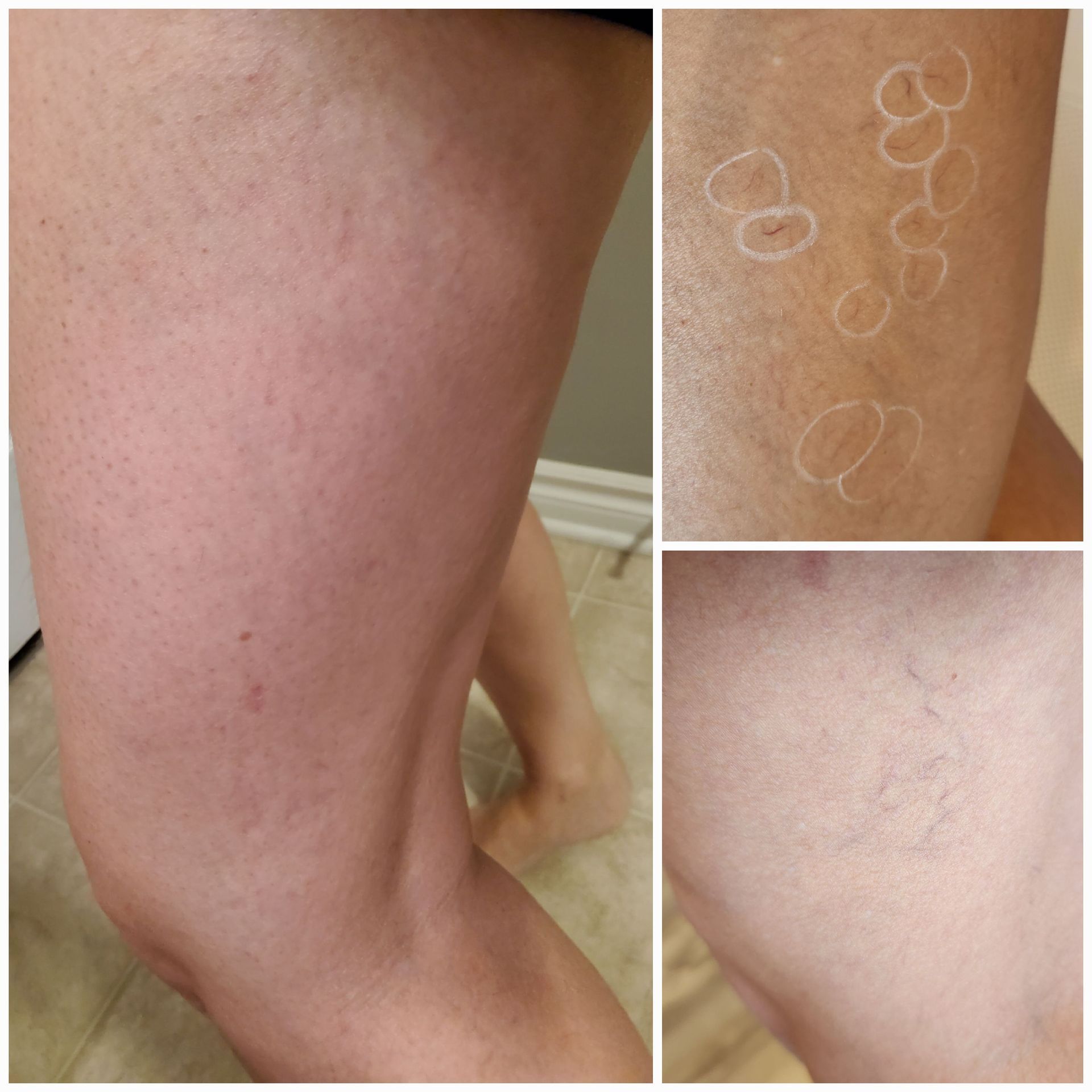 A collage of three pictures of a woman 's leg with varicose veins.