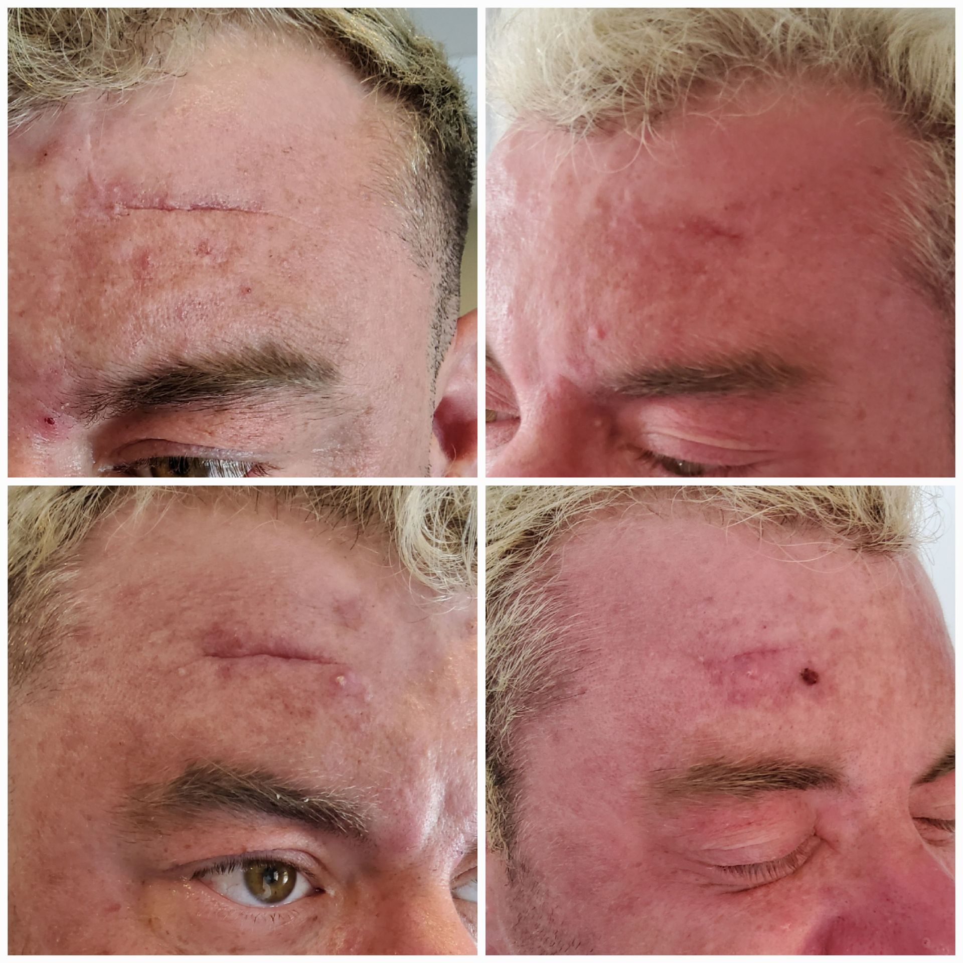 Four pictures of a man 's face showing different stages of healing