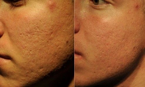 A before and after photo of a man 's face with acne.