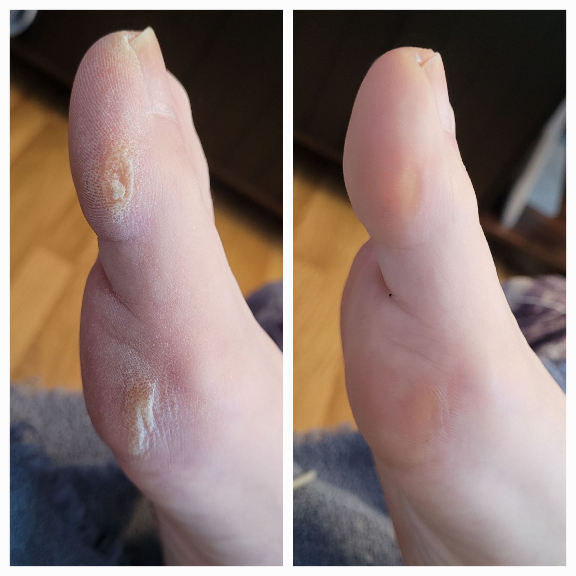 A before and after photo of a person 's foot