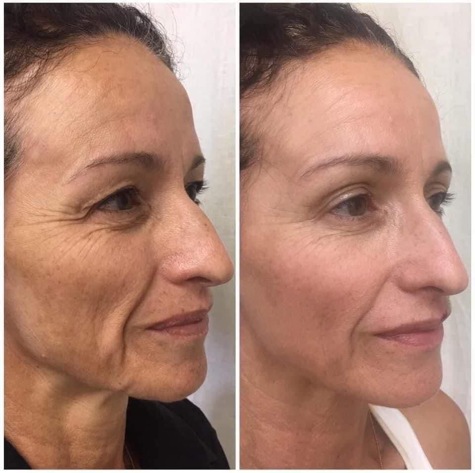 A before and after photo of a woman's face.