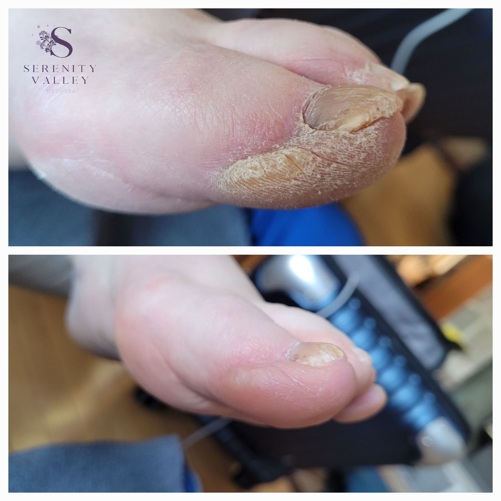 A before and after photo of a person 's foot.