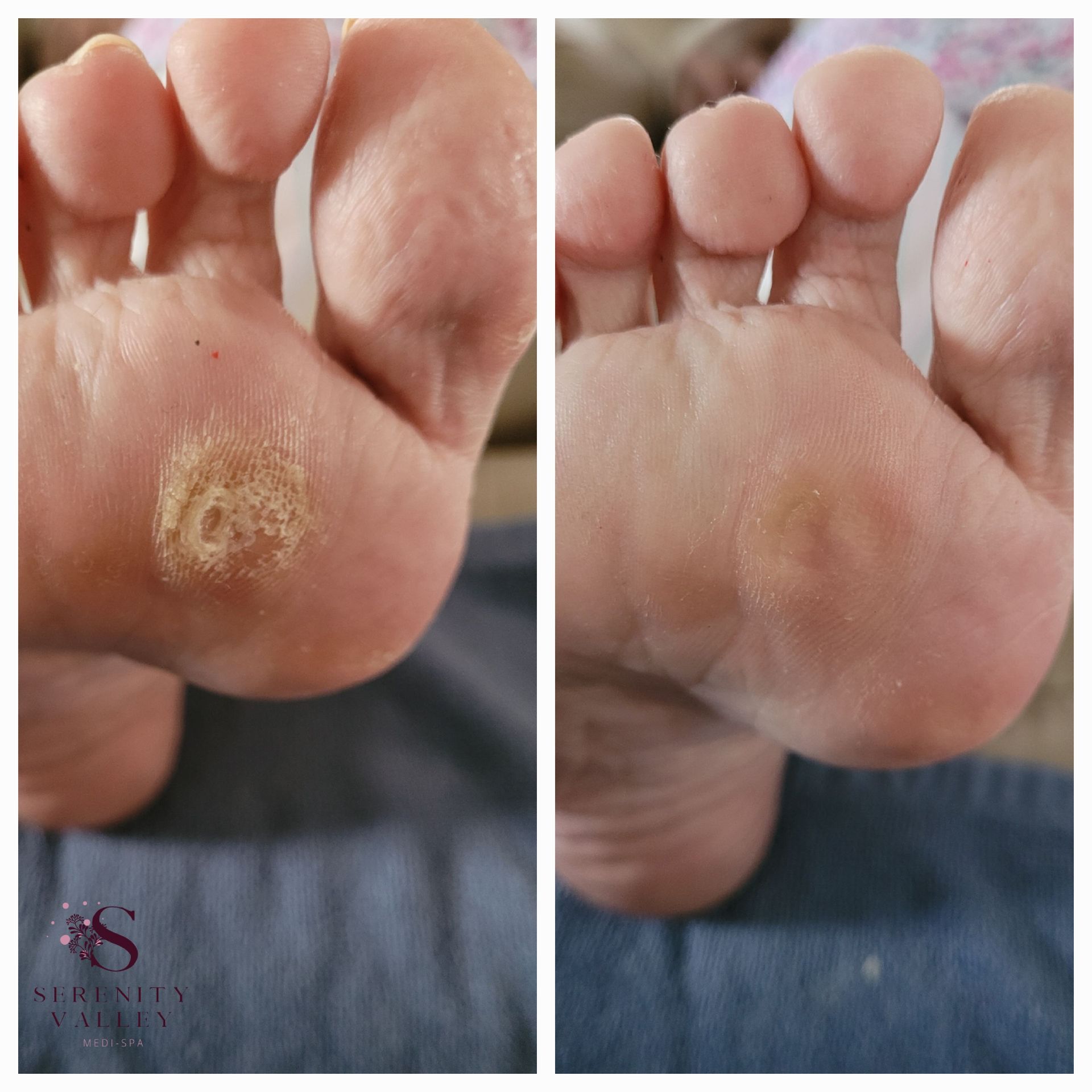 A before and after photo of a person 's foot with a wart on it.