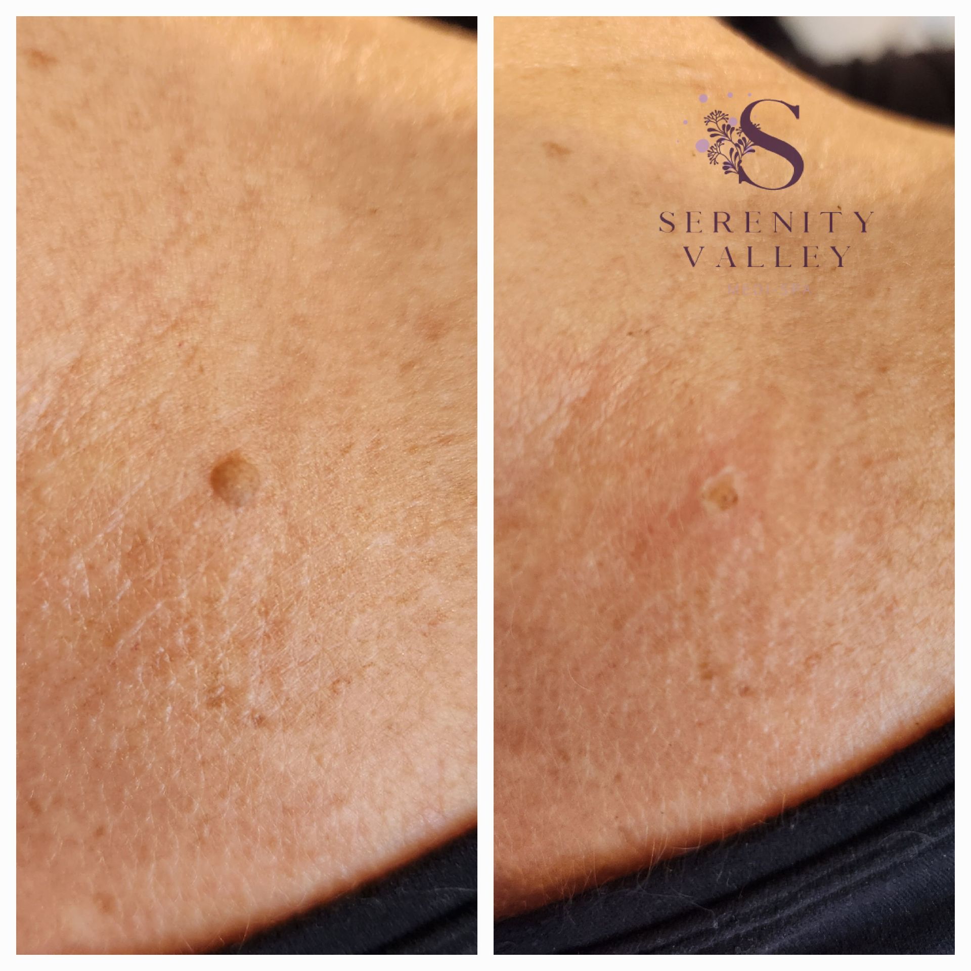 A before and after photo of a woman 's skin with serenity valley written on the bottom