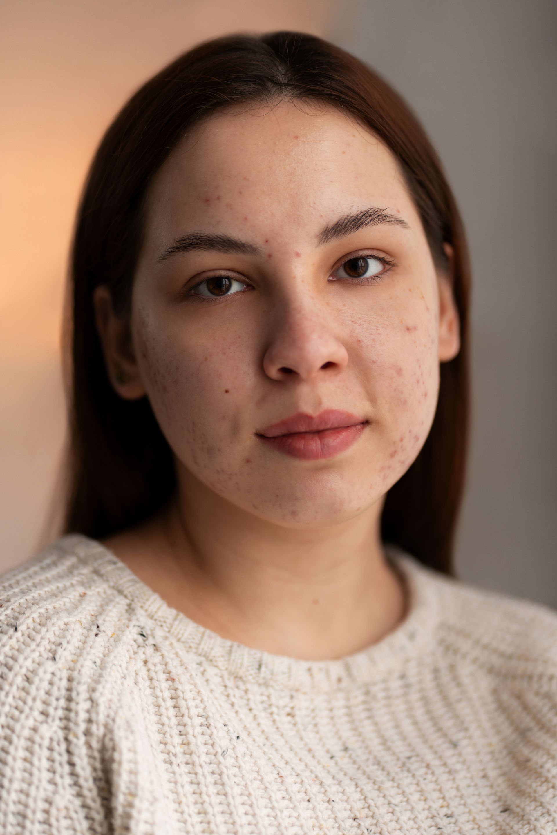 A woman with acne on her face is wearing a white sweater and looking at the camera.