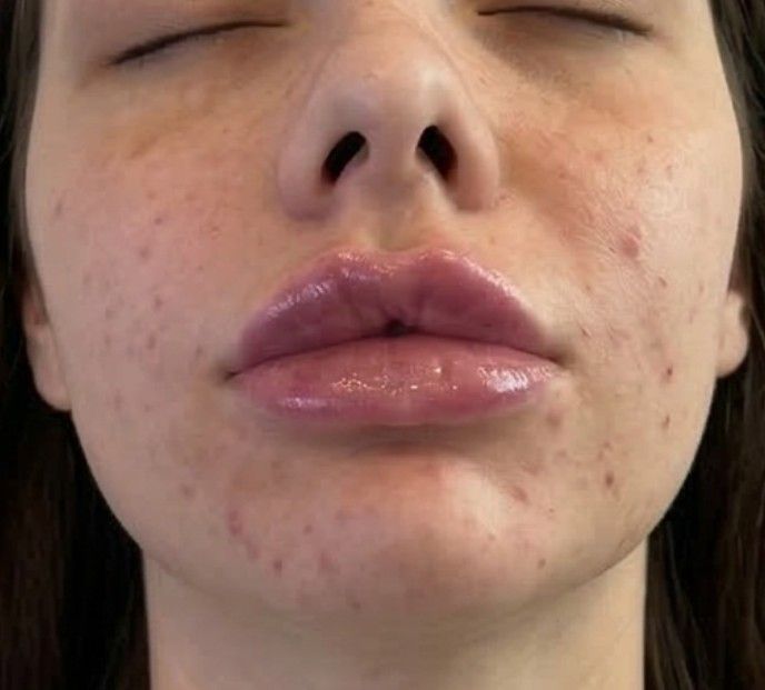 after lip filler treatment at Signature Aesthetics in Nottingham