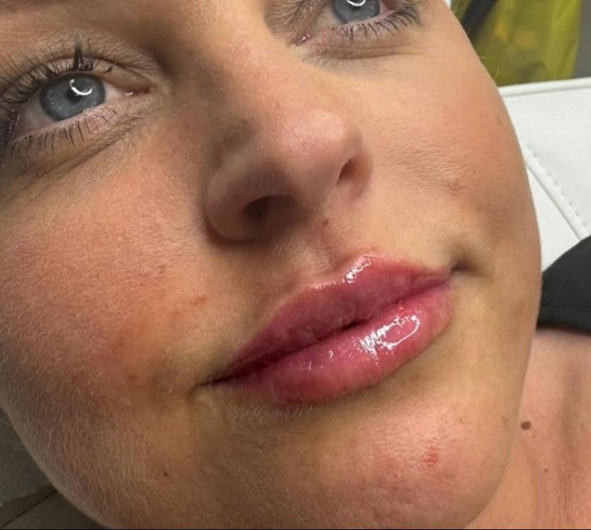 Signature Aesthetics client after 1ml dermal lip filler treatment