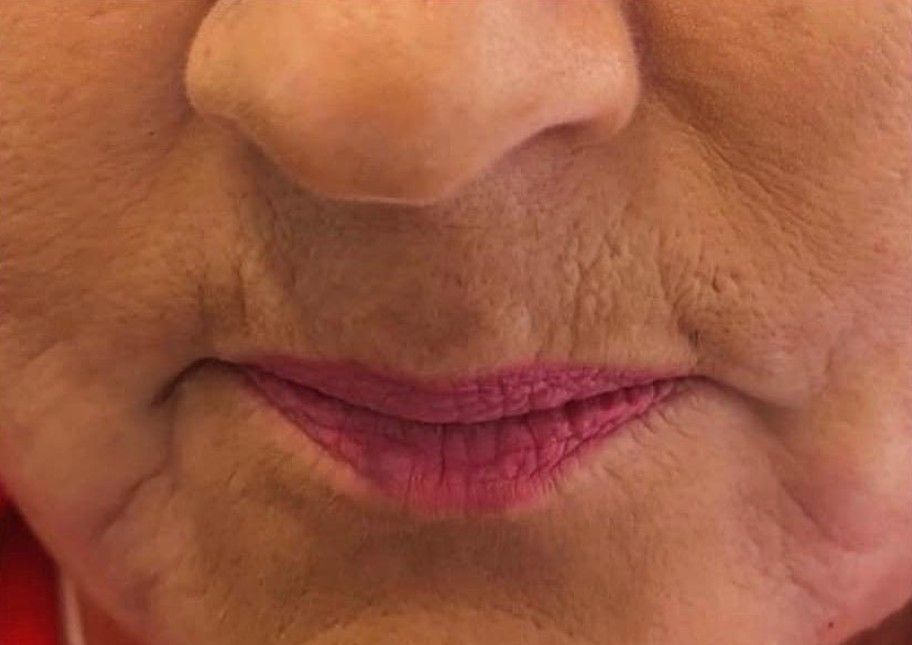 after marionette lines treatment at Signature Aesthetics in nottingham