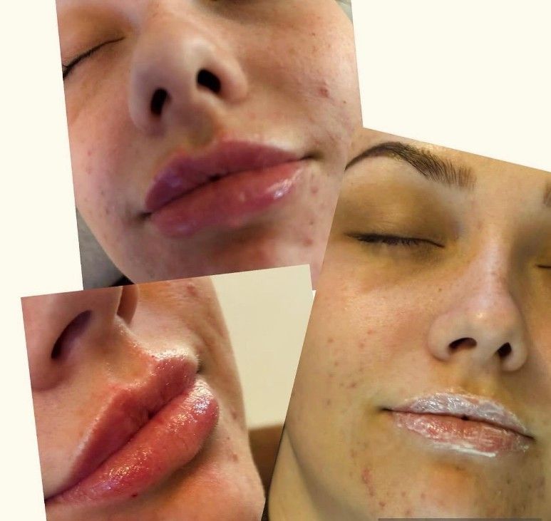 Signature Aesthetics client after 1ml lip filler treatment