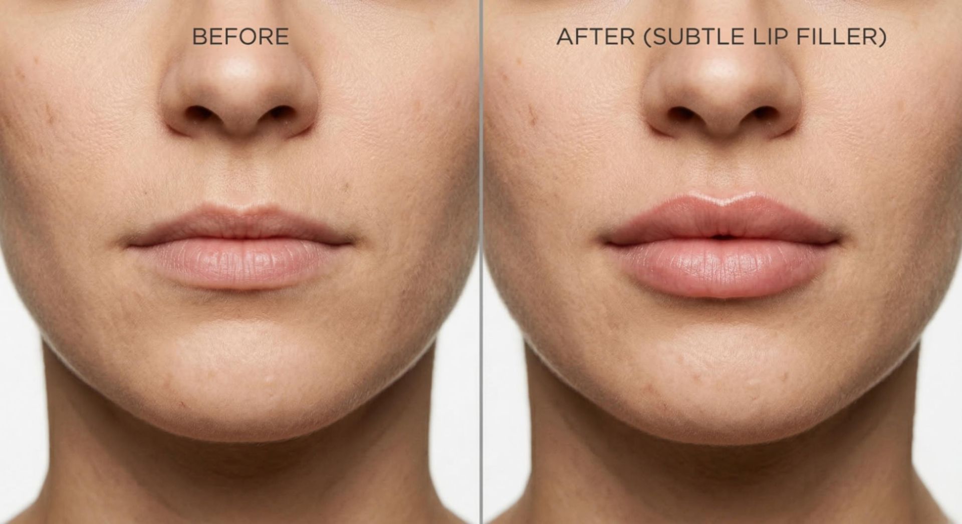 Before and after lip filler comparison showing natural volume enhancement and improved definition at Signature Aesthetics Nottingham