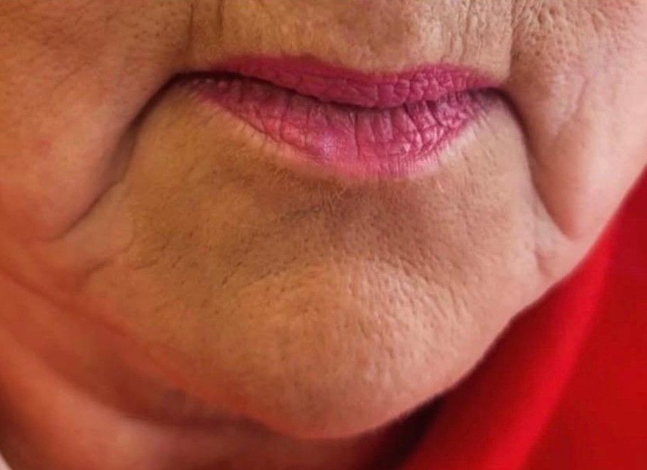 before marionette lines treatment