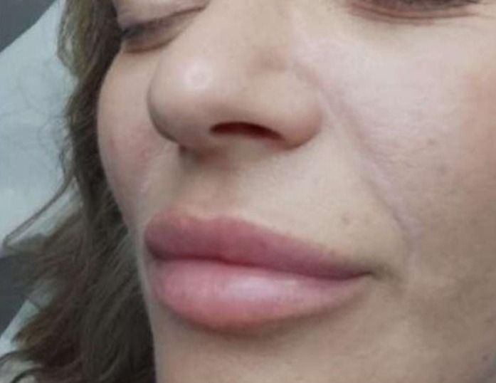 before nasal fold treatment at Signature Aesthetics in Nottingham