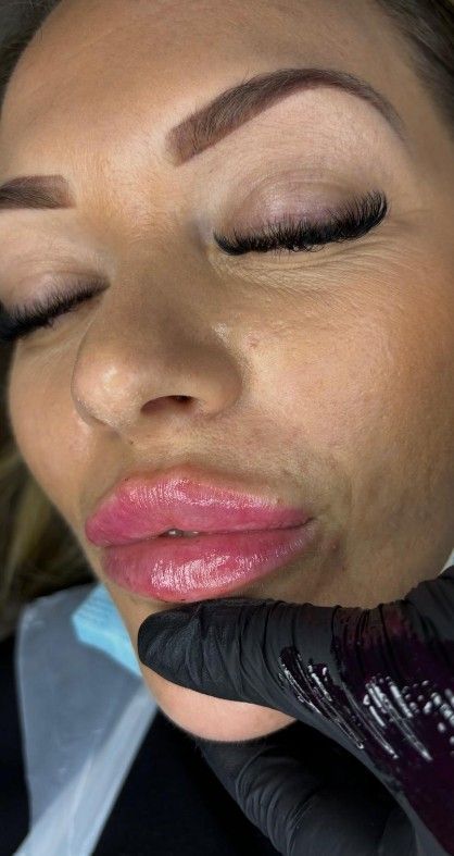 Signature Aesthetics client after dermal lip filler treatment