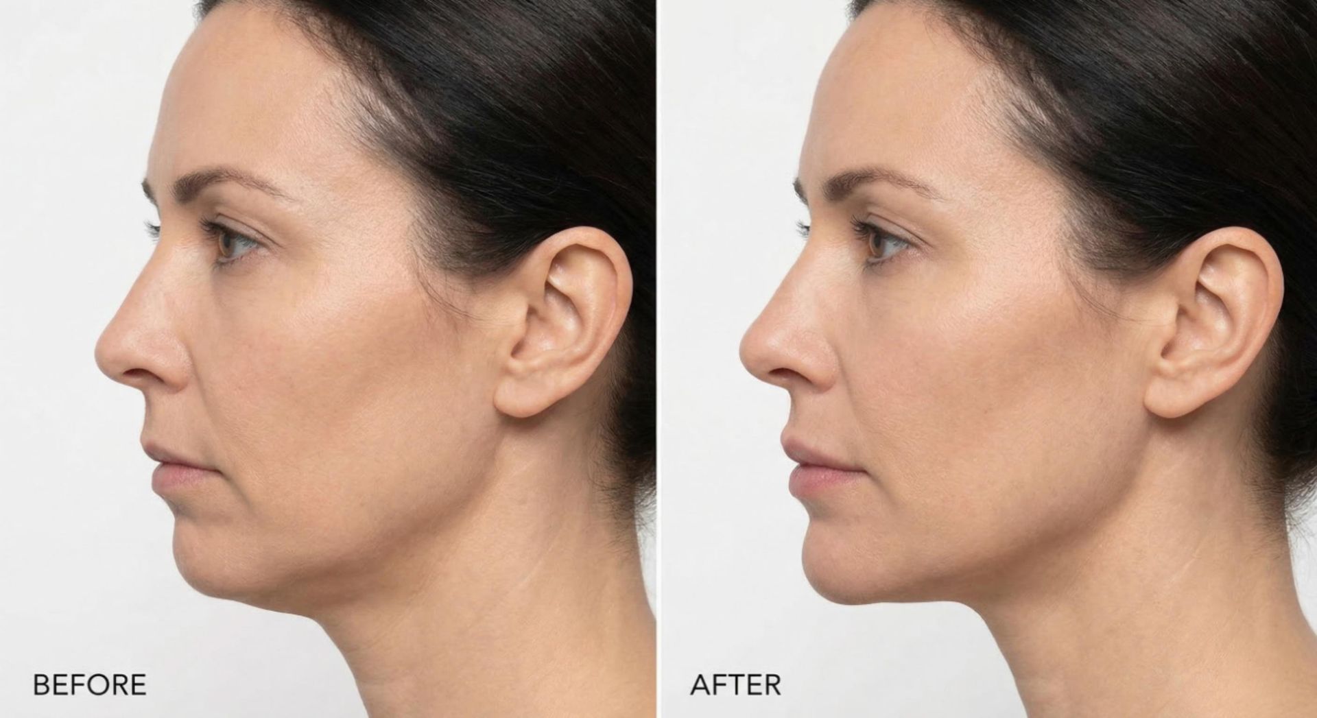 Side profile before and after comparison showing improved chin projection and facial balance with chin filler at Signature Aesthetics Nottingham