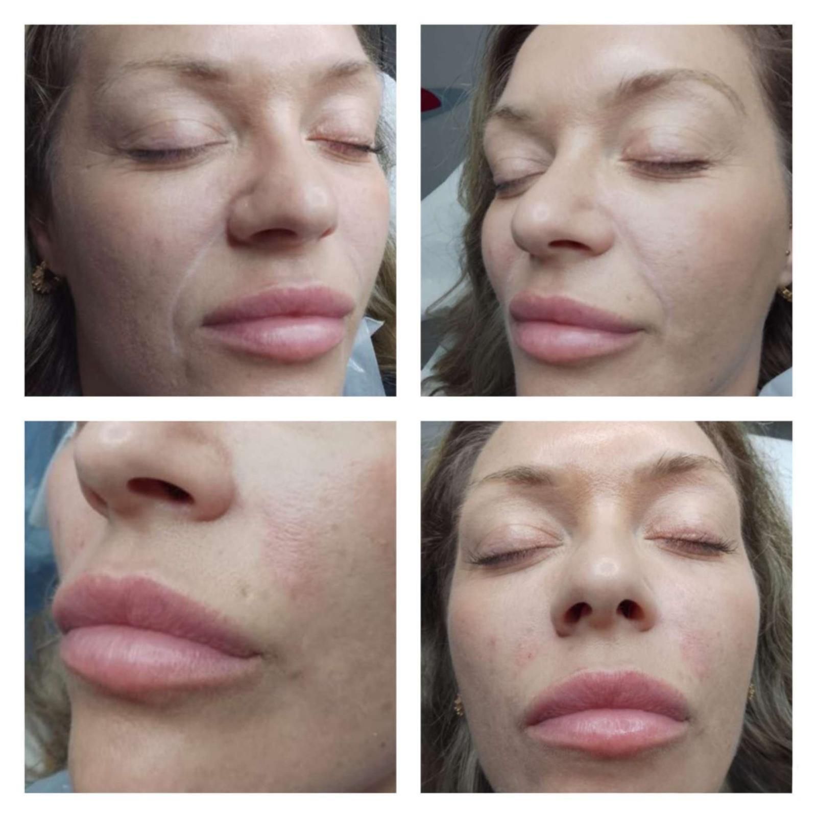 Selection of before and after client images showing natural nasolabial fold softening using dermal filler at Signature Aesthetics Nottingham