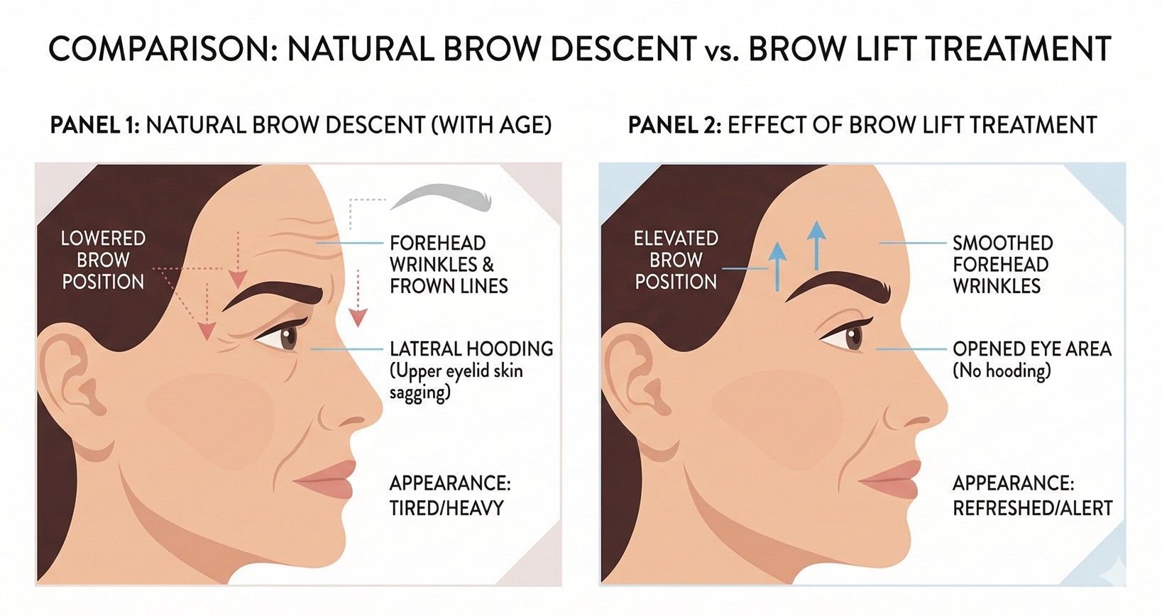 Anatomical diagram showing the key muscles involved in a non-surgical brow lift treatment using anti-wrinkle injections