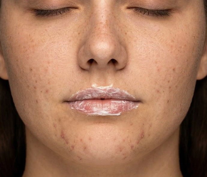 before lip filler treatment at Signature Aesthetics in Nottingham