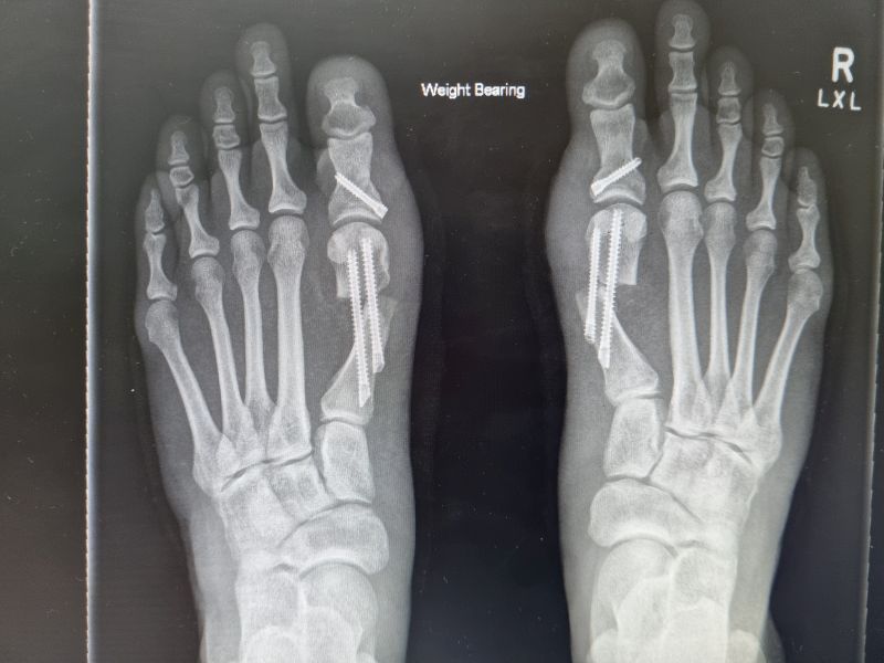 An x-ray of a person 's feet with a broken toe.