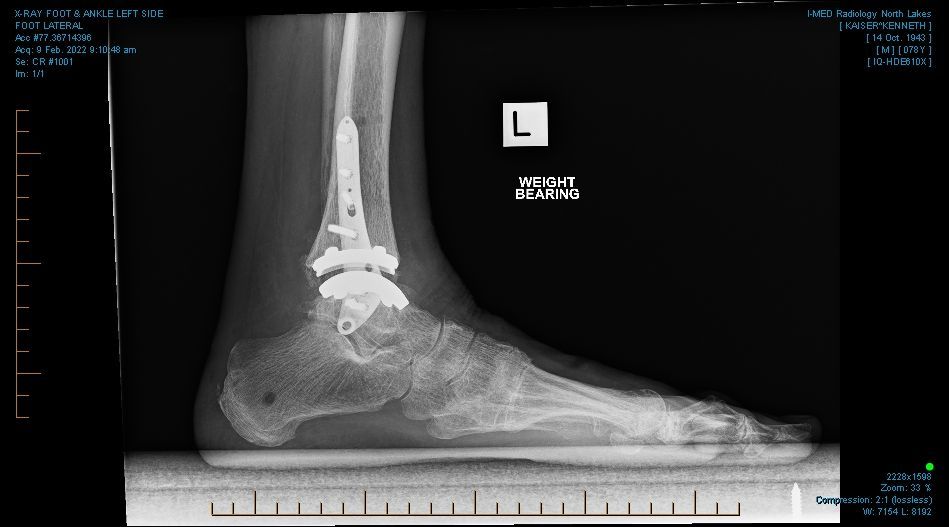 ANKLE REPLACEMENT UPDATES