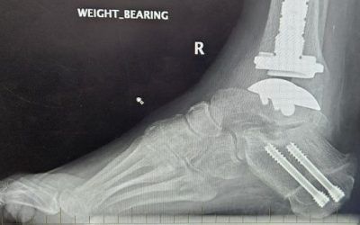 An x-ray of a person's foot with weight bearing written on it